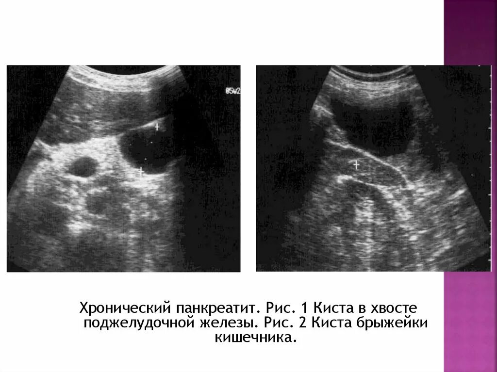 Фиброзные изменения поджелудочной