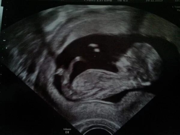 эмбрион на 11 неделе беременности узи. снимок узи 11 недель беременности. узи 10-11 недель беременности. узи ребенка 11 недель. узи ребенка 11 недель.