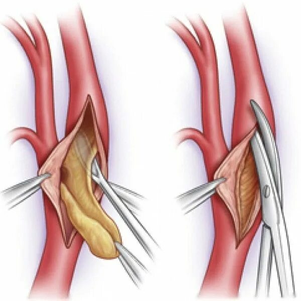 Каротидная эндартерэктомия. Операция каротидная эндартерэктомия. Эверсионная каротидная эндартерэктомия. Эндартерэктомия сонной артерии. Бляшка на шее операция