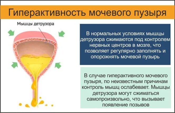 Удаление мочевого пузыря сколько. Гиперактивный мочевой пузырь. Гипоактивныймочевой пузырь. Гиперактивный мочевой пузырь у женщин. Гиперреактиврый мочевой пцзырь.