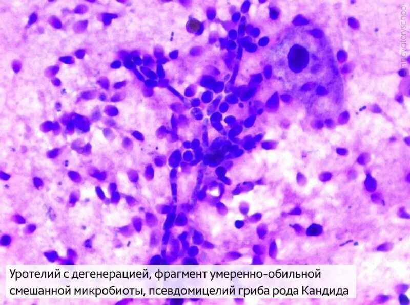Цитологический атлас шейки матки. Клетки фолликулярного эпителия щитовидной железы тироциты. Клетки с дегенеративными изменениями в цитологии. Пролиферация железистого эпителия расшифровка. Цитологические признаки.