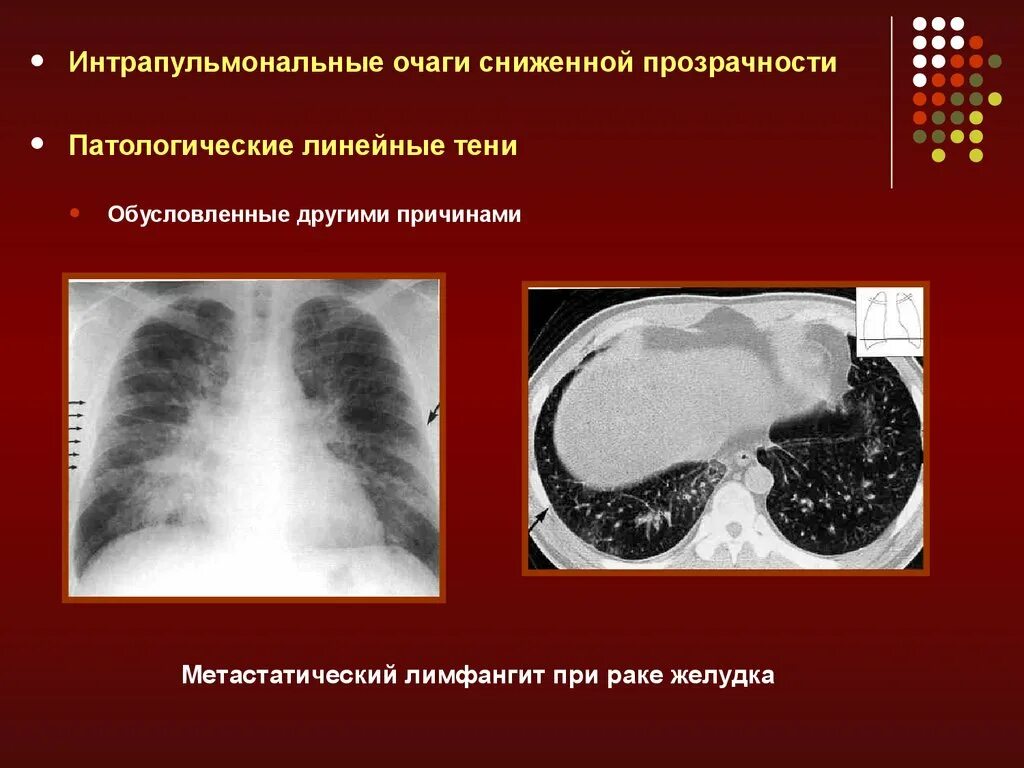 Лучевые заболевания легких. Рентгенодиагностика заболеваний легких. Раковый лимфангит легких. Метастатический лимфангит.