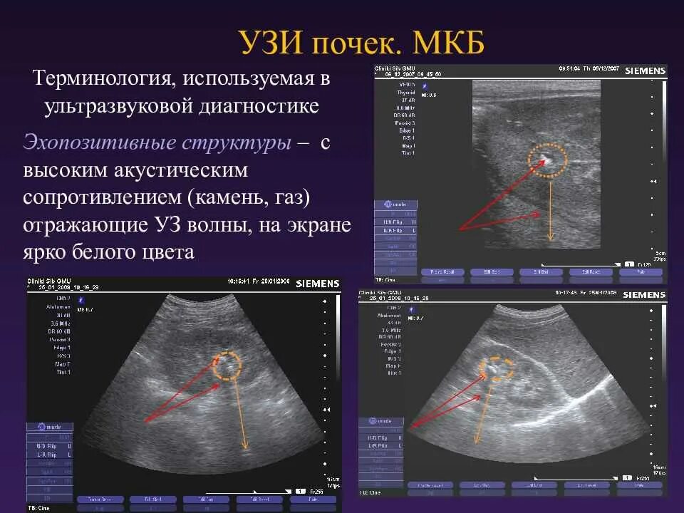Мкд почек. Узи анатомия почек измерение размеров по узи. мочекаменная болезнь узи. мкб на узи почек. мочекаменная болезнь узи почек.