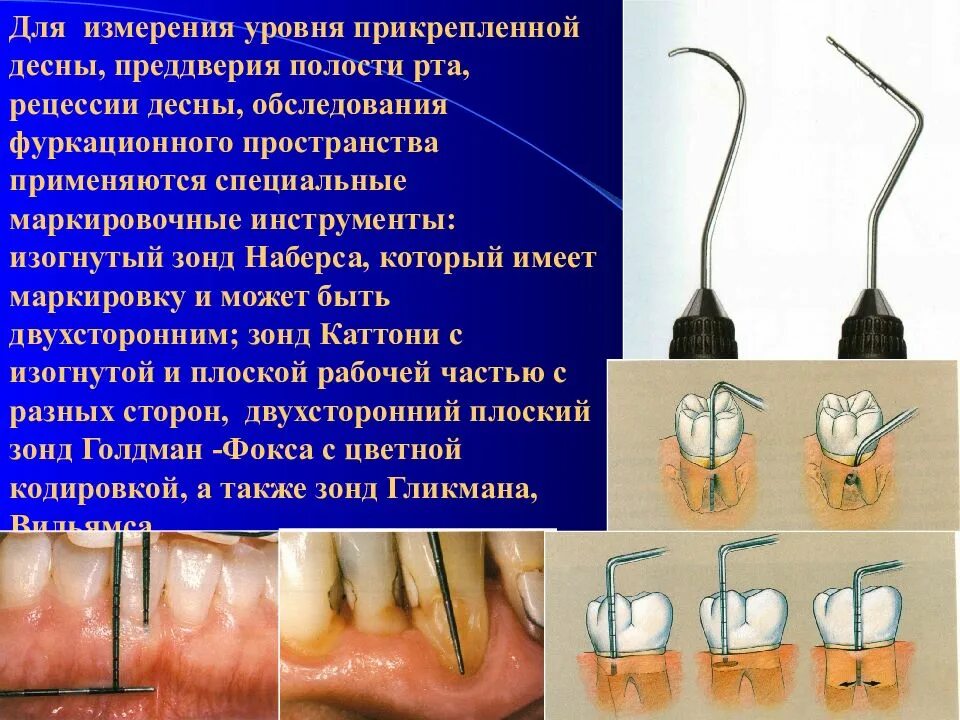 Измерение глубины преддверия полости рта. Глубина преддверия полости рта. Инструменты для осмотра ротовой полости. Классификация глубины преддверия полости рта. Прикрепленная десна