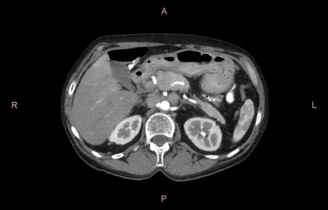 Можно курить перед кт. Мрт ОБП+забрюшинное пространство. Кт ОБП И забрюшинного пространства. Томограмма брюшной полости кт.