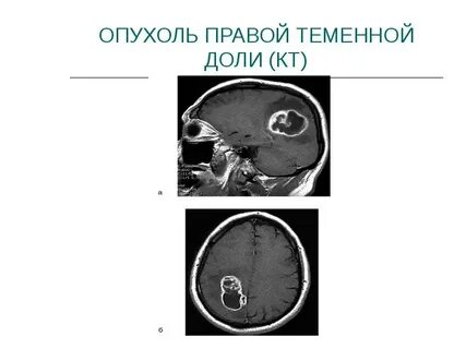 Опухоль на кт