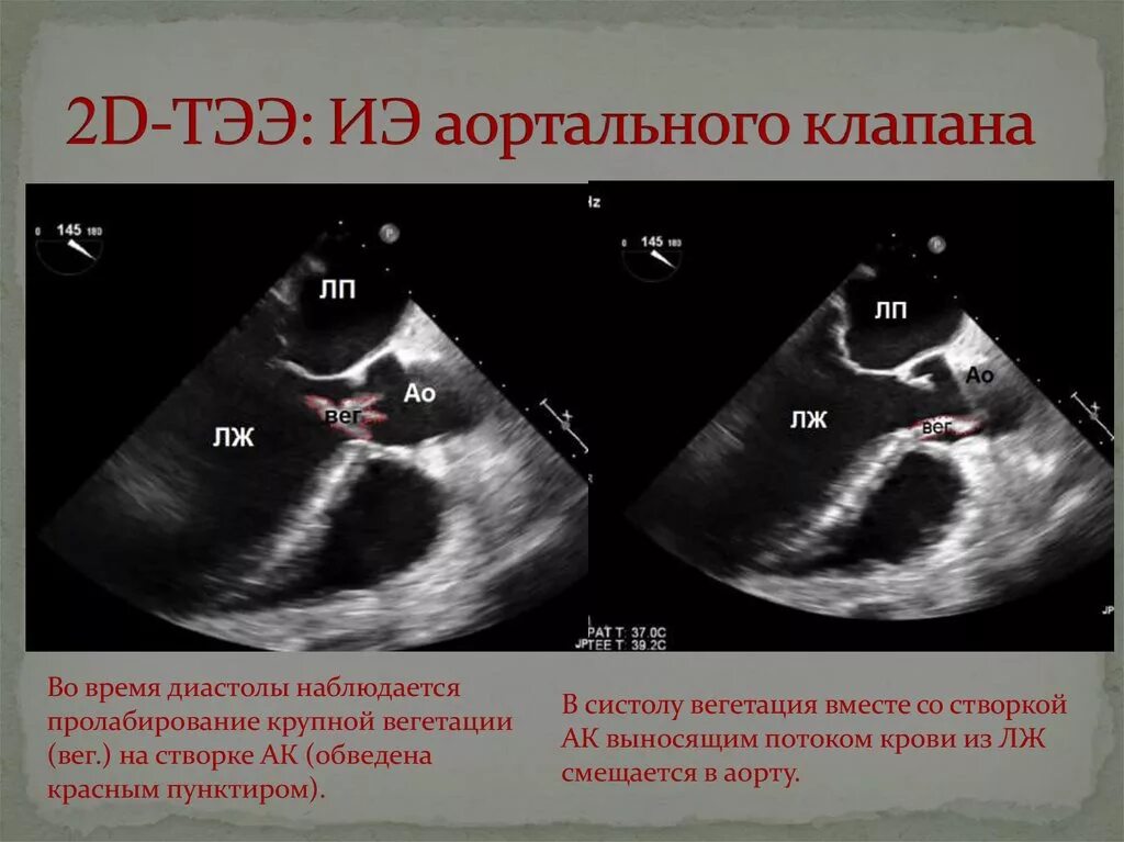 Эндокардит митрального клапана УЗИ. Инфекционный эндокардит эхокардиография. Aortal stenoz exokardiographia. Двустворчатый аортальный клапан на УЗИ. Вегетация у детей