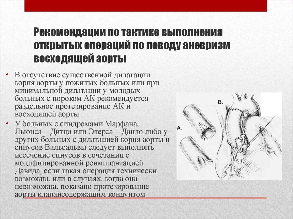 Аневризма показания к операции. Мешотчатая аневризма восходящего отдела аорты. Хирургия аневризма восходящего отдела аорты. Операции при аневризмах аорты. Операция при аневризме аорты.