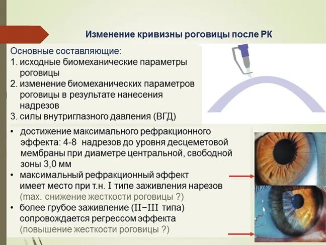 Внутриглазное давление. Роговично компенсированное внутриглазное давление. Механизм повышения внутриглазного давления. Радиальные насечки на роговице.