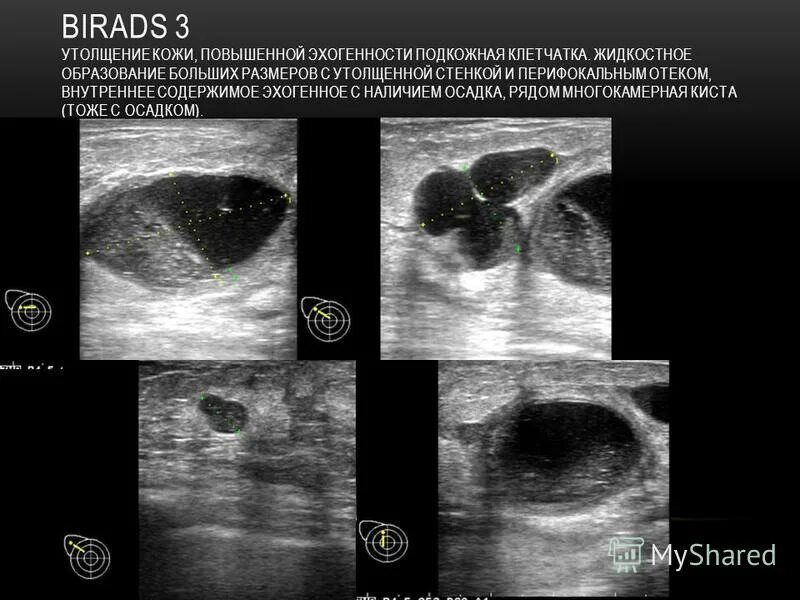 Что такое bi rads 3 на маммографии. Birads 1 молочной железы что это такое. Классификация образований молочной железы на УЗИ по bi-rads. Маммография молочных желез bi rads 1. Киста яичника o rads