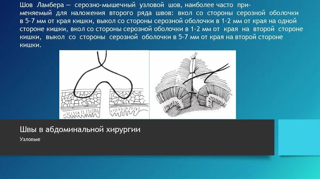 Стерильный шов. Кишечные швы Ламбера и Шмидена. Ламбера шов кишечный в ветеринарии. Серозно мышечный шов Ламбера.