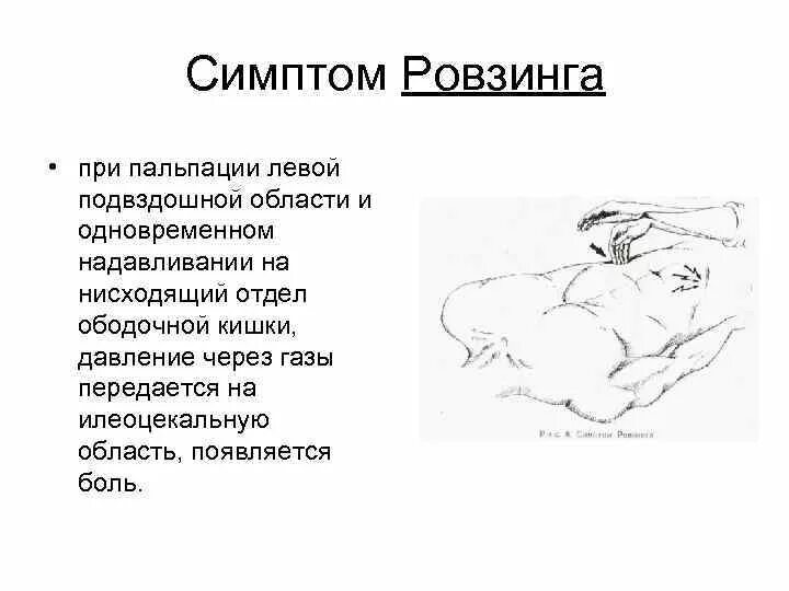 Пальпация при остром животе. Симптомы Ровзинга Ситковского Бартомье-Михельсона. Симптомы Щеткина -Блюмберга Ситковского Ровзинга. Синдром Щеткина -Блюмберга пальпация. Острый аппендицит симптом Щеткина Блюмберга.