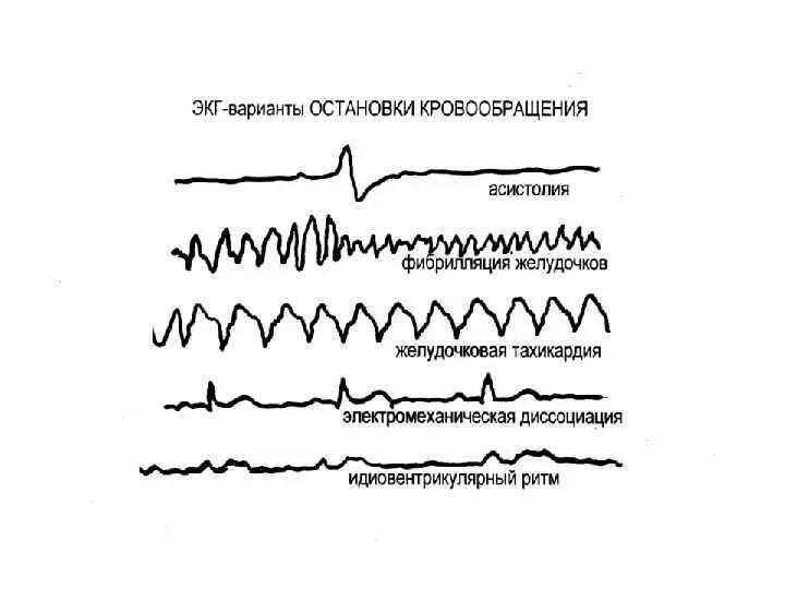 Варианты остановки кровообращения. Асистолия и фибрилляция желудочков. Асистолия сердца на ЭКГ. Механизмы остановки сердца асистолия фибрилляция. ЭКГ признаки остановки кровообращения.