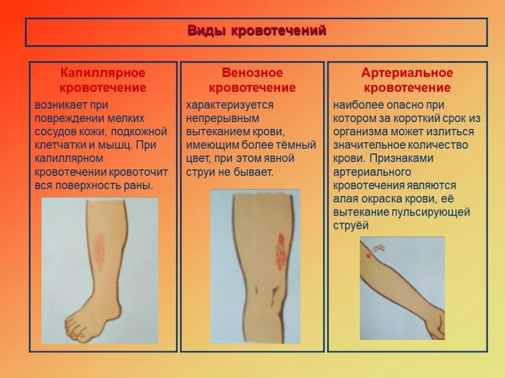 Первая помощь при кровотечениях обж 8 класс. Таблица признак артериальное венозное капиллярное. Артериальное венозное и капиллярное кровотечение. Артериальная венозная капиллярная кровь таблица. Артериальное венозное капиллярное кровотечение биология.