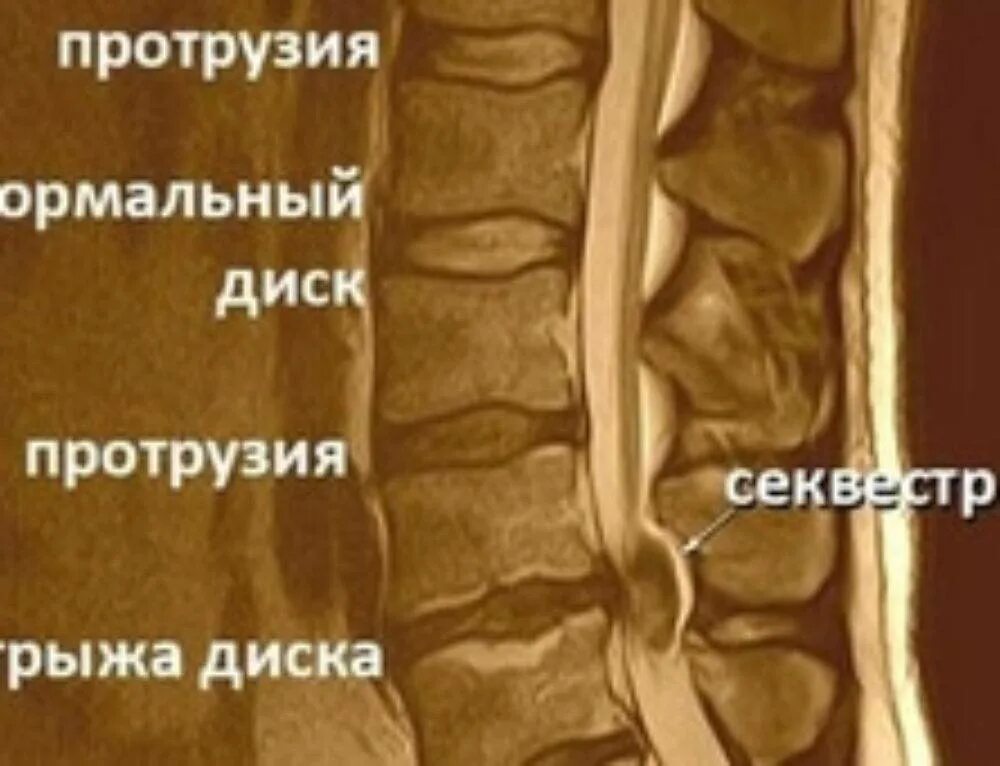 Протрузия шейного отдела позвоночника симптомы. Грыжа диска позвоночника l5 s1. Секвестрированная грыжа l5-s1 мрт. Позвоночная грыжа l1-l2. Симптомы грыжи поясничного отдела l5-s1.