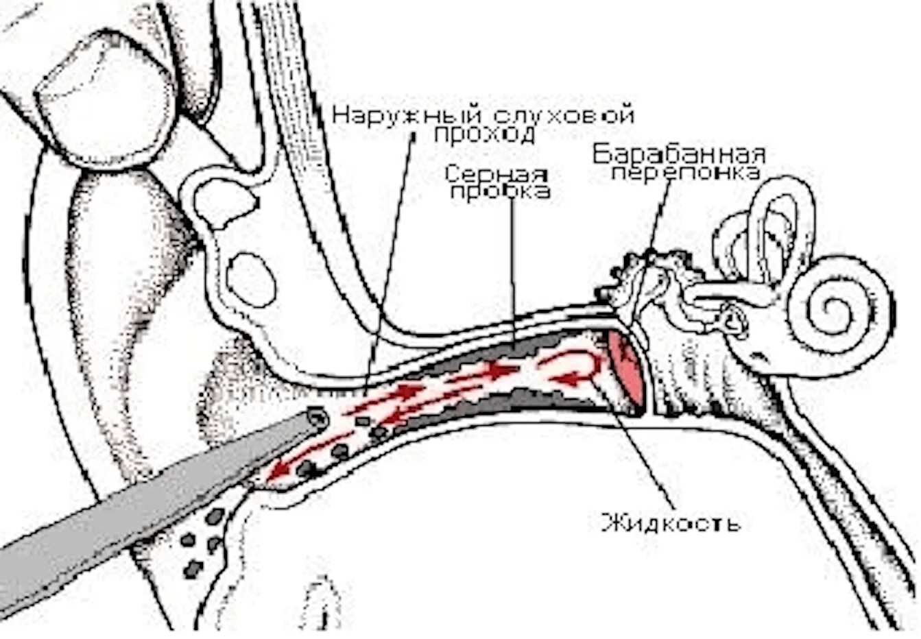 Алгоритм промывания серной пробки. Серная пробка на барабанной перепонке. Серная пробка наружного слухового прохода. Промывка уха от серной пробки схема. Что делать если в ухе застряла вода