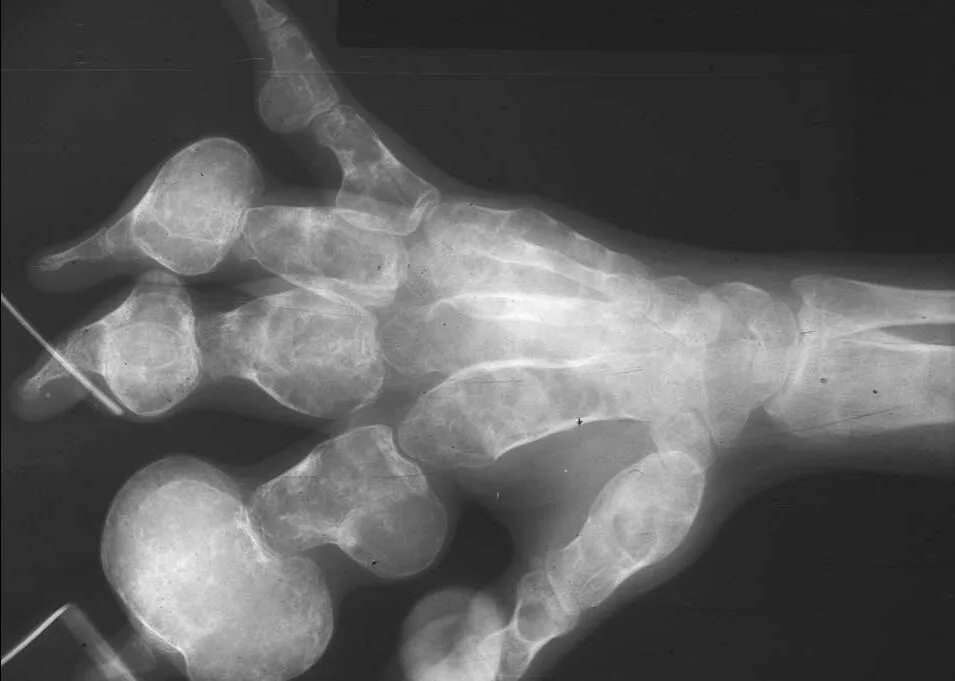 остеофиты головки плечевой кости. артрит плюсневых костей. шишка на суставе большого пальца. костного нароста рук. костного нароста рук.