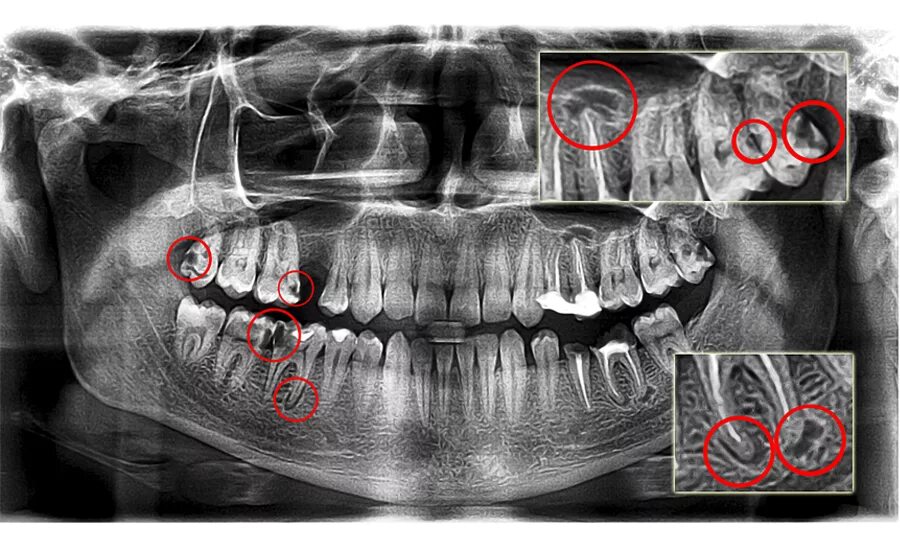 Снимок зубов видное. Хронический периодонтит на ортопантомограмма. Ортопантомограмма челюсти. Ортопантомограмма кариес.