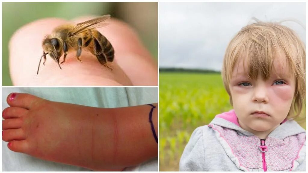 Que Hacer En Caso De Ataque De Abejas Clearance podlokot.ru