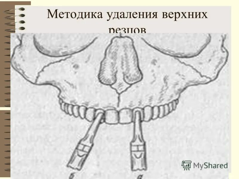 Выдергивание корня зуба. Удалить резцы. Наложение щечек щипцов на зуб. Удалить резцы. Удаление верхнего резца.