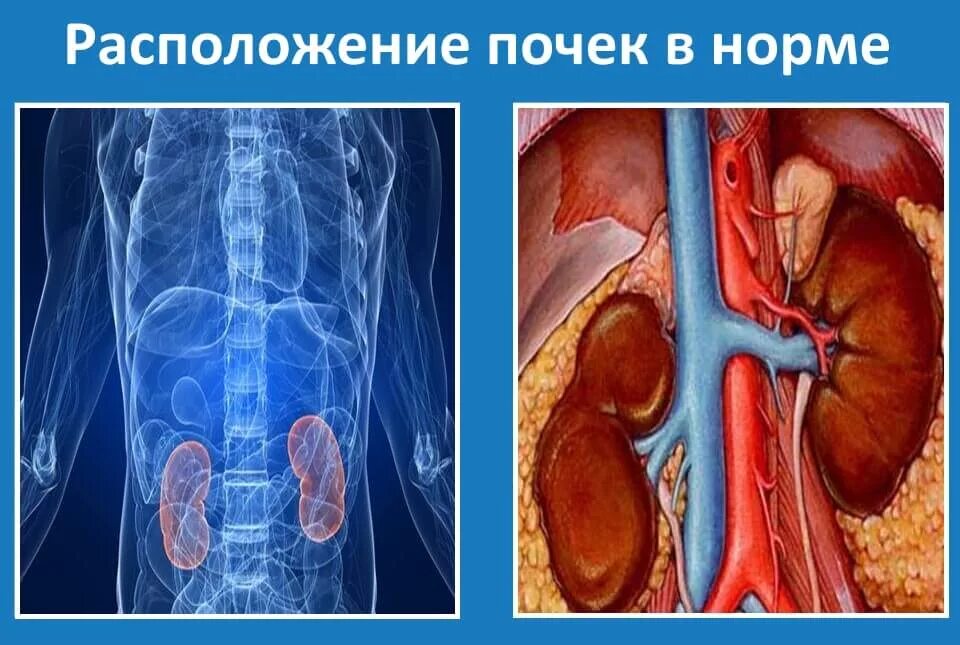 Почки справа у мужчин. Нефроптоз почки урография. Нефроптоз почки мкб.