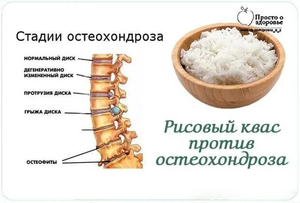 От остеохондроза. Продукты при остеохондрозе. Рецепт от остеохондроза. Народные средства при остеохондрозе. Компрессы при остеохондрозе