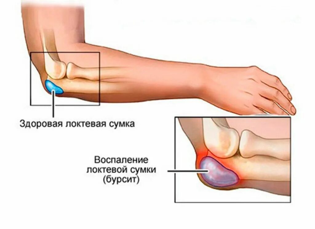 Почему болят локтевые сгибы. Суставная сумка локтевого сустава. Синовиальные сумки голеностопного сустава. Околосуставные сумки локтевого сустава. Бурсит локтевого отростка рентген.