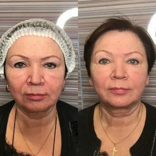Скульптурный массаж до и после