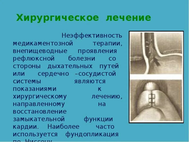 Лекарство при грыже пищевода. Хирургические методы лечения ГЭРБ. Хирургическое лечения заболеваний пищевода. Хирургическая операция при ГЭРБ.