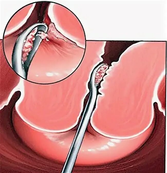 Как называется выскабливание. Выскабливание цервикального канала шейки. Эндоцервикальный кюретаж. Выскабливание внутреннего слоя матки. Диагностическое выскабливание слизистой матки.