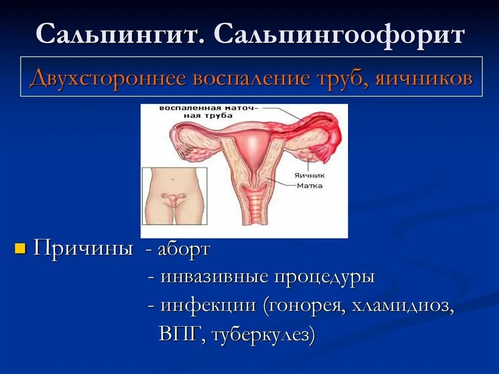 Двусторонний сальпингоофорит. Двусторонний сальпингоофорит. Сальпингоофорит перитонит. Сальпингоофорит презентация. Клинические симптомы острого сальпингоофорита.