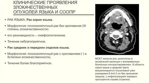 Злокачественный опухоль 3 стадия