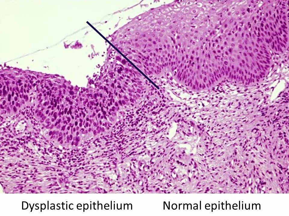 Дисплазия шейки матки гистология. Дисплазия шейки матки микропрепарат. Дисплазия матки гистология. Дисплазия плоского эпителия гистология.