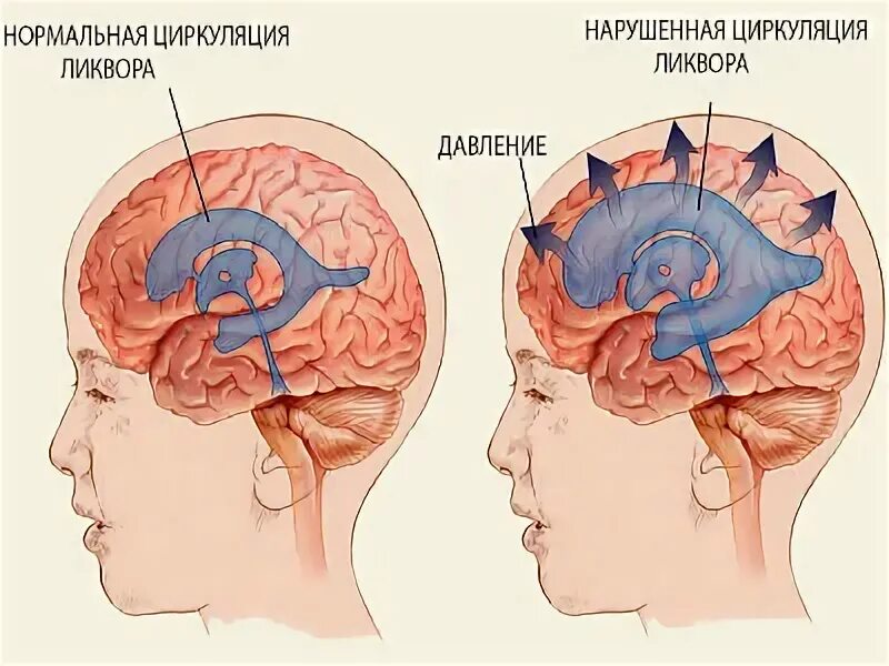 Умеренно выраженной наружной гидроцефалии у взрослых