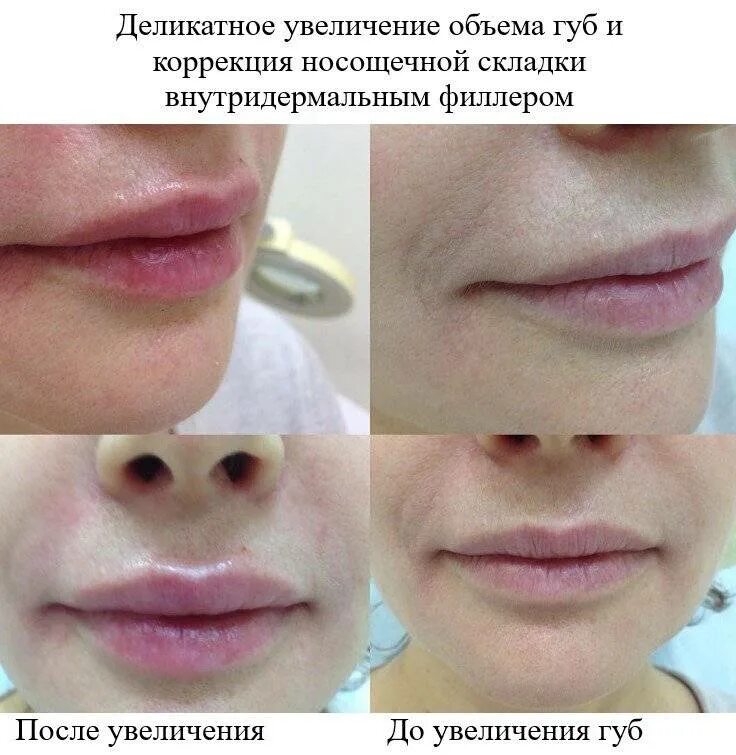 Сколько держится увеличение губ гиалуроновой кислотой. Губы после контурной пластики. губы с 3 мл гиалуроновой кислоты.