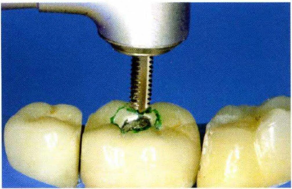 Металлокерамический коронка можно мрт. Металлокерамическая коронка. Снятие металлокерамической коронки. Восстановление зуба коронкой металлокерамической.