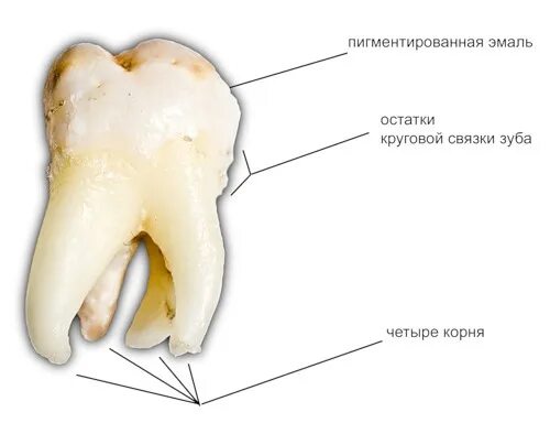 Корни зуба мудрости сверху.