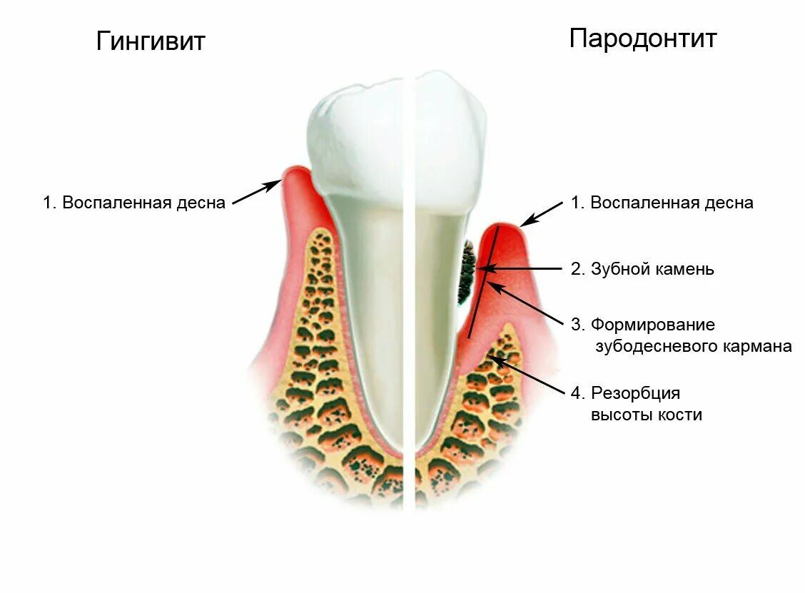 Почему поднимается десна зуба. Локализованный пародонтит. Воспаление десны гингивит. Рецессия десны лоскутная операция. Гипертрофический гингивит фиброзная форма клиника.