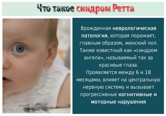 Что такое айси синдром у детей фото. Синдром ретта причины. синдром рета у детей что это.