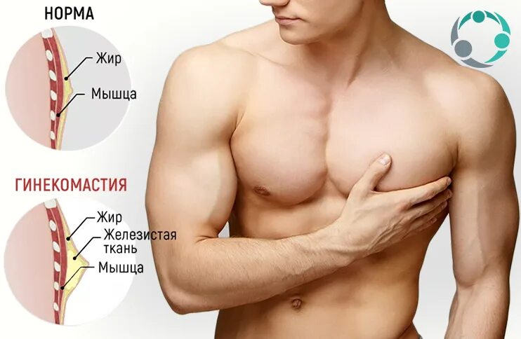 Гинекомастия как определить