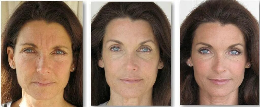 Плазмолифтинг отзывы фото до и после лицо. Плазмотерапия лица до и после. Плазмотерапия(лифтинг).