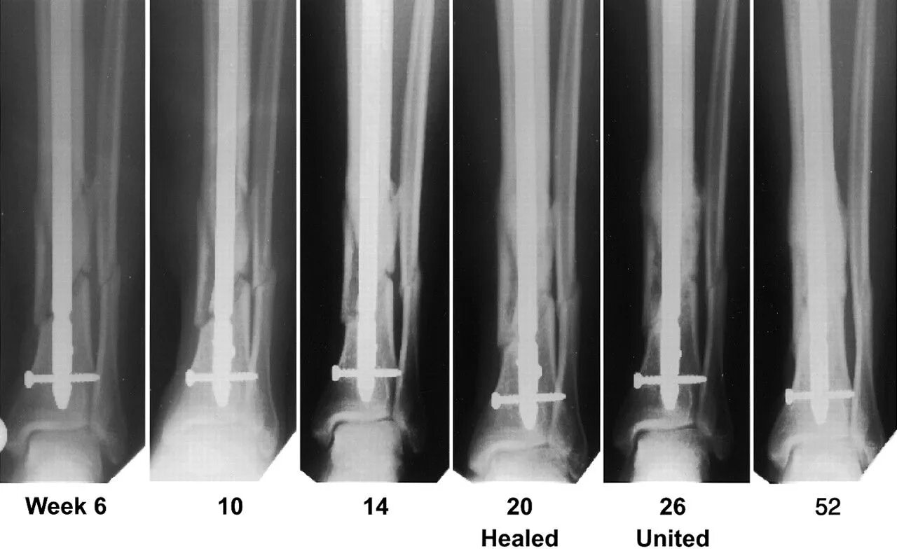 Трещина заживает. Винтообразный перелом голени. Спиральный перелом большеберцовой кости. Винтовой перелом большеберцовой кости. Винтообразный перелом костей голени.