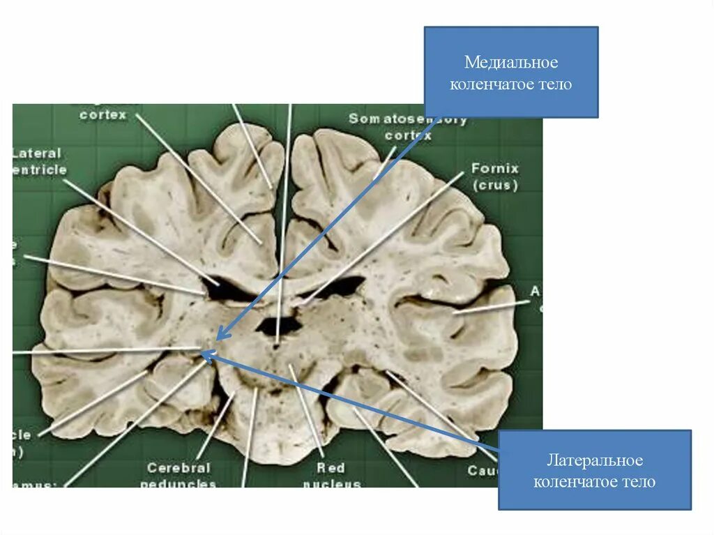 Коленчатые тела мозга. Медиальные коленчатые тела промежуточного мозга. Медиальное коленчатое тело таламуса. Латеральное коленчатое тело. Медиальное коленчатое тело на препарате.