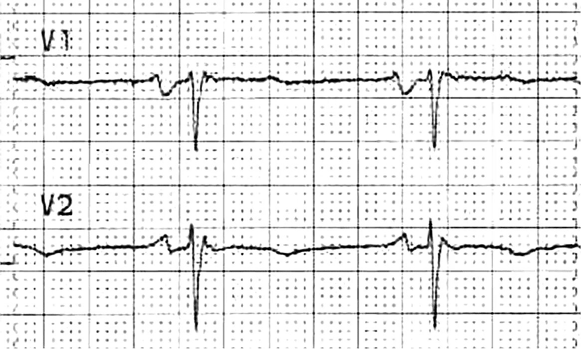 Удлинение комплекса qrs