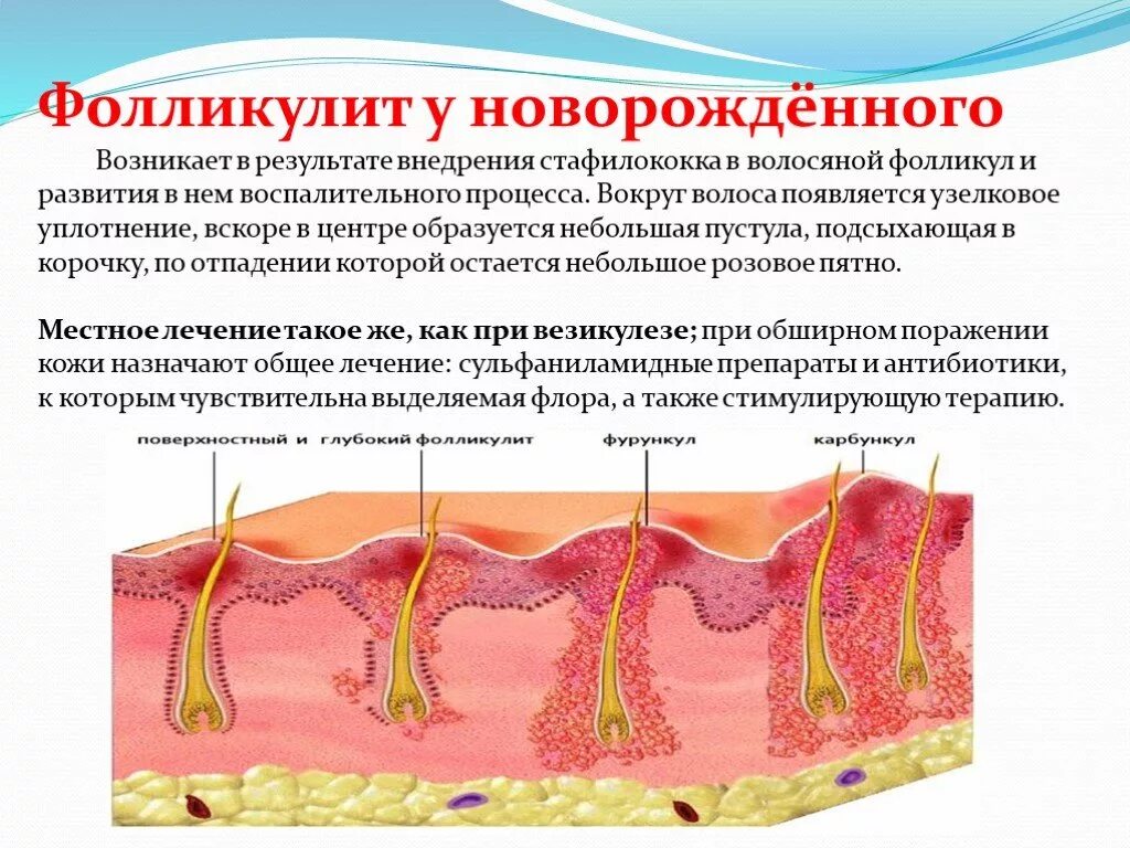 Фурункулез волосяных фолликулов. Эпилирующий фолликулит. Фолликулит – воспаление волосяных фолликул.. Лечение фолликулов