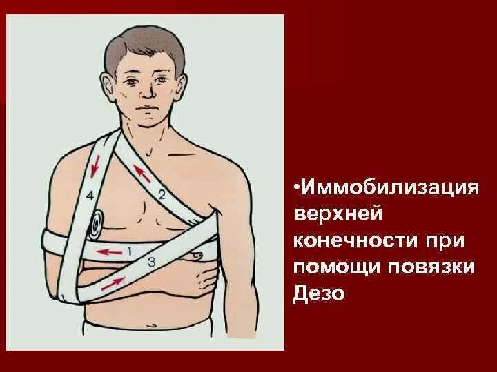 Повязка дезо как делать. Повязка дезо при переломе ключицы. иммобилизация повязкой дезо. наложение повязки дезо алгоритм. повязка дезо на плечевой сустав техника.