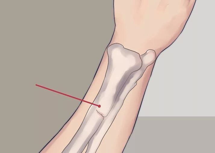 Почему болит кость после перелома. Поднадкостничные переломы. Перелом голени лучевой кости. Перелом надкостницы лучевой кости. Надкостница перелом надкостницы.