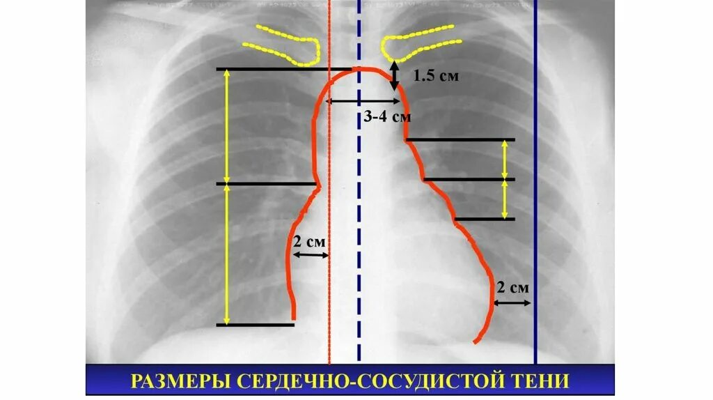 Границы расширены влево. Лучевая анатомия (рентгеновское изображение) сердца в норме. Тень сердца на рентгенограмме в норме. Дуги сердца на рентгенограмме. Ркнигкн анатомия сердца.