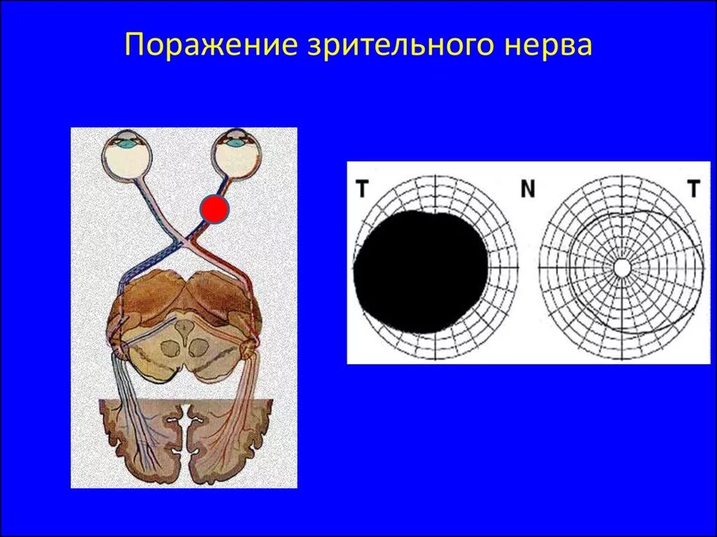 Поражение зрительного нерва. Симптомы поражения зрительного нерва. Поражение глазного нерва. Зрительный нерв поля зрения. Монимен