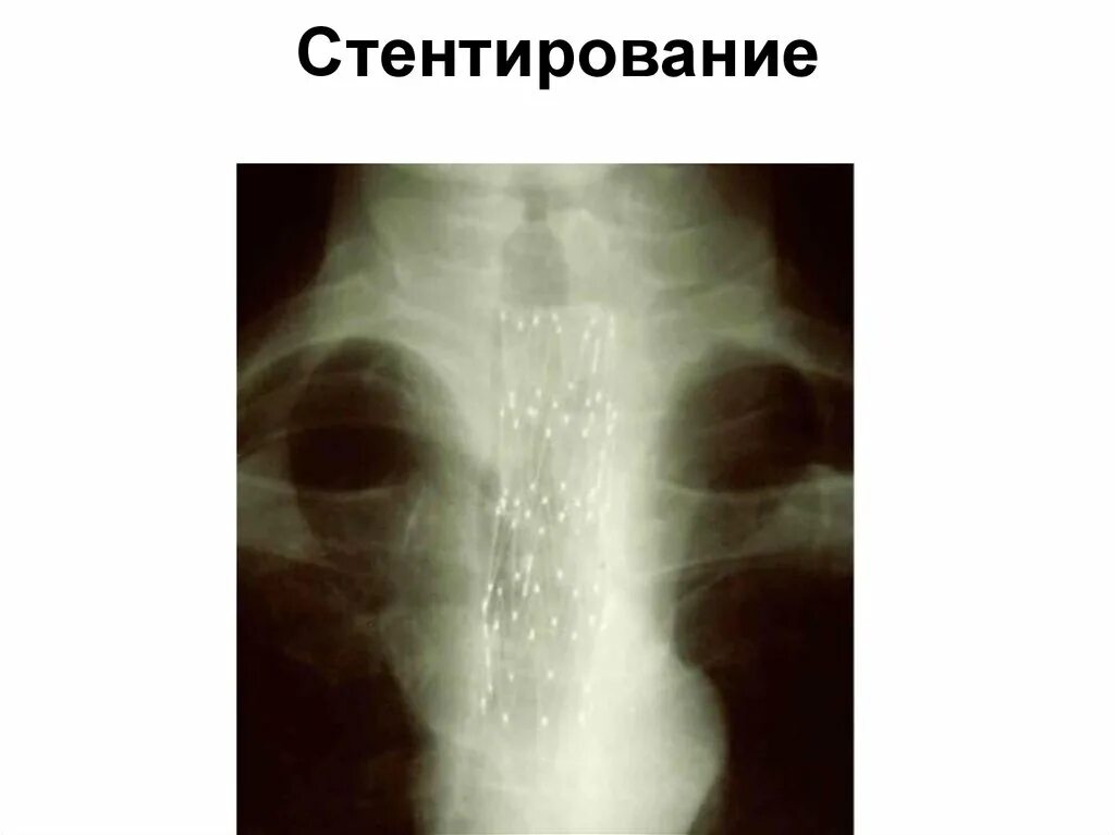 Пищевода выживаемость. Разрыв пищевода рентген. Стентирование пищевода рентген. Стентирование пищевода рентгеноскопия. Рентген при разрыве пищевода.